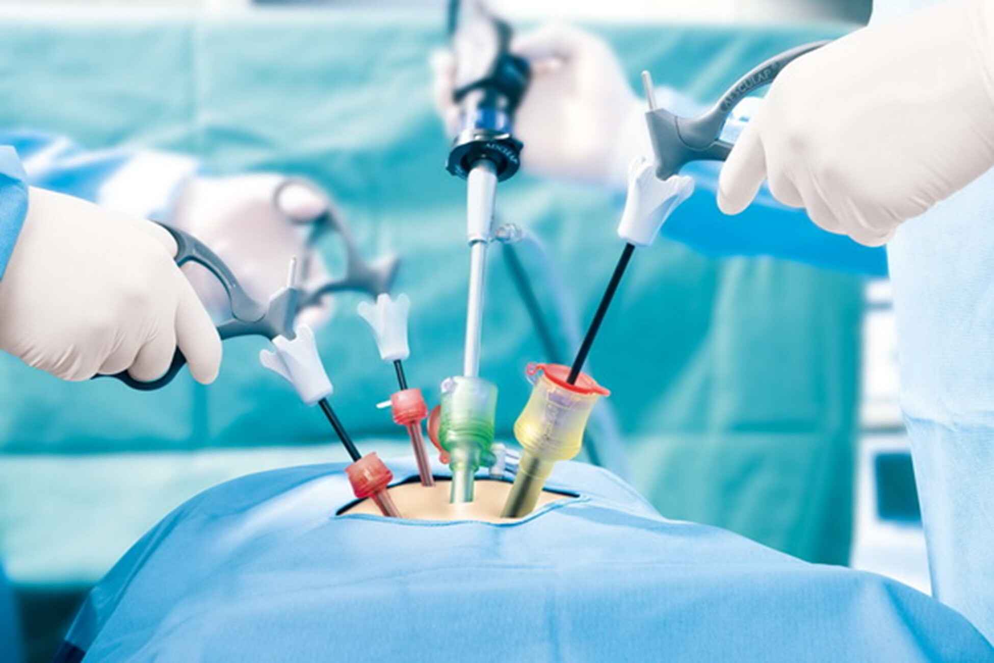 mini laparoscopic surgery